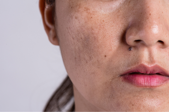 Why Pigmentation Occurs on Face