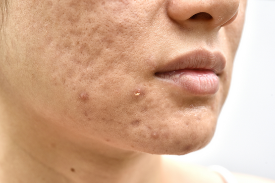 How to Get Rid of Pimples: Signs, Causes & Treatment