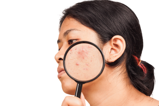 Debunking the Myth: Are Black Spots on the Face Permanent?
