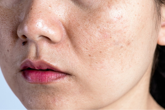 Unveiling the Mystery: Understanding the Causes and Treatment of Pigmentation
