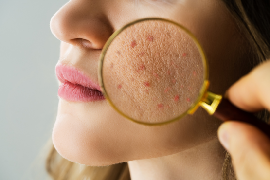 Anti-Aging Skincare for Acne-Prone Skin